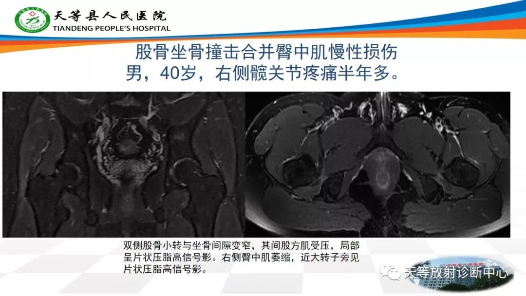 影像PPT - 【PPT】大转子疼痛综合征-14 影像PPT - 【PPT】大转子疼痛综合征-14