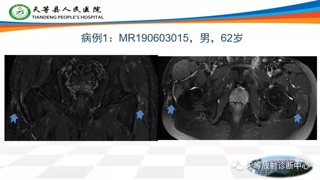 影像PPT - 【PPT】大转子疼痛综合征-2 影像PPT - 【PPT】大转子疼痛综合征-2