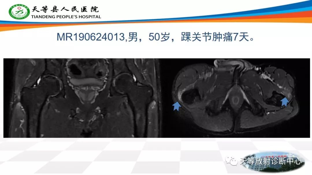 影像PPT - 【PPT】大转子疼痛综合征-6 影像PPT - 【PPT】大转子疼痛综合征-6