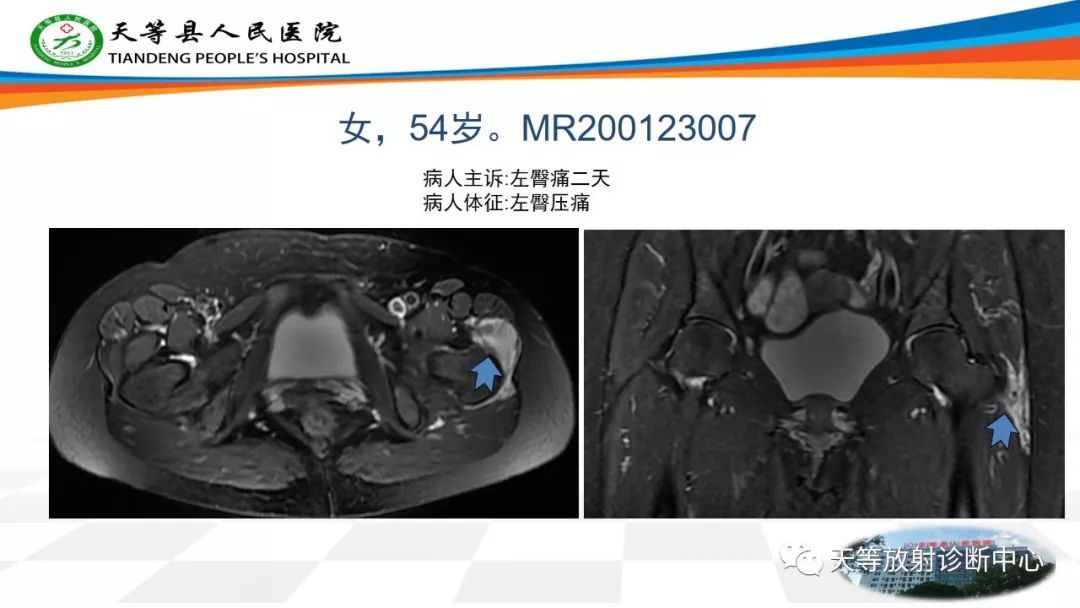 影像PPT - 【PPT】大转子疼痛综合征-16 影像PPT - 【PPT】大转子疼痛综合征-16