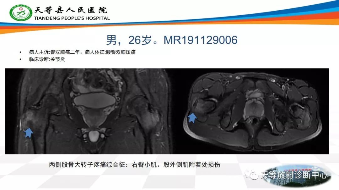 影像PPT - 【PPT】大转子疼痛综合征-15 影像PPT - 【PPT】大转子疼痛综合征-15