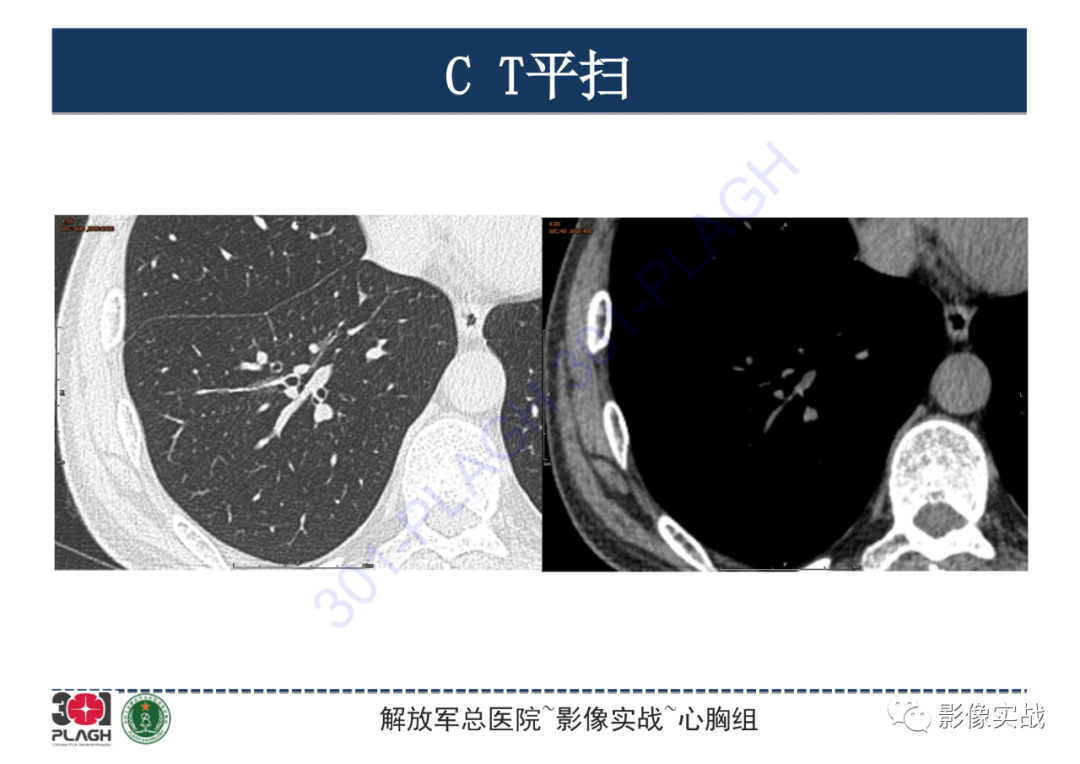 影像PPT - 【PPT】肺浸润性腺癌1例CT-4