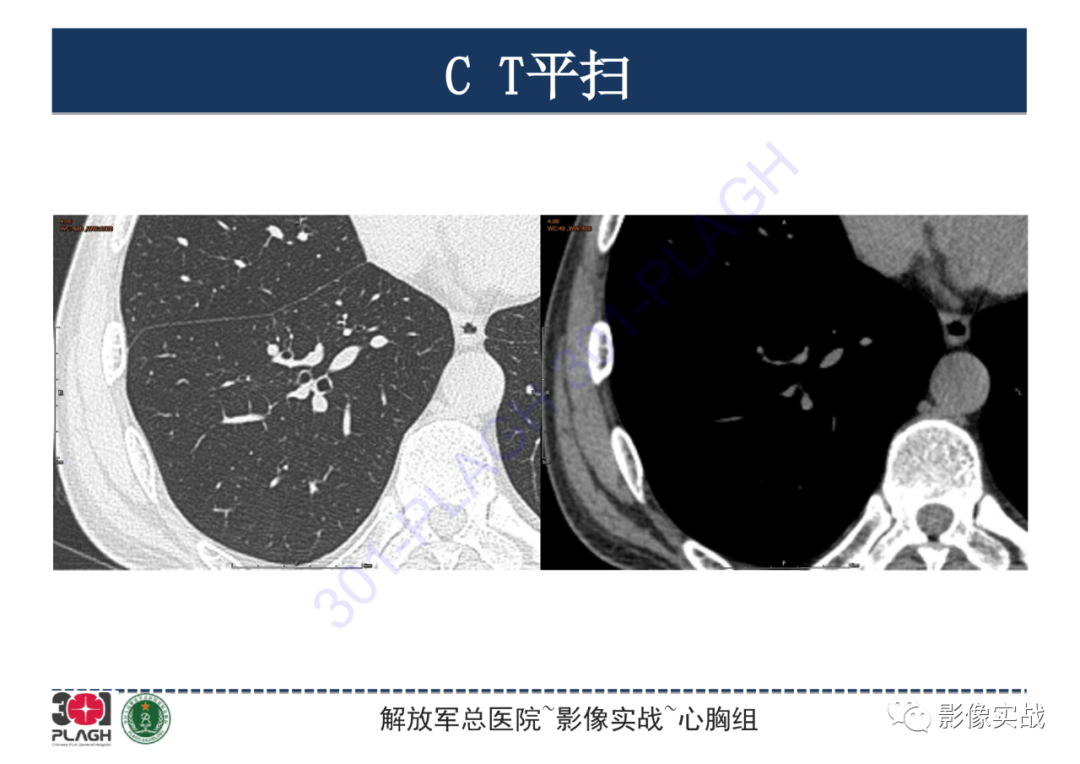 影像PPT - 【PPT】肺浸润性腺癌1例CT-3