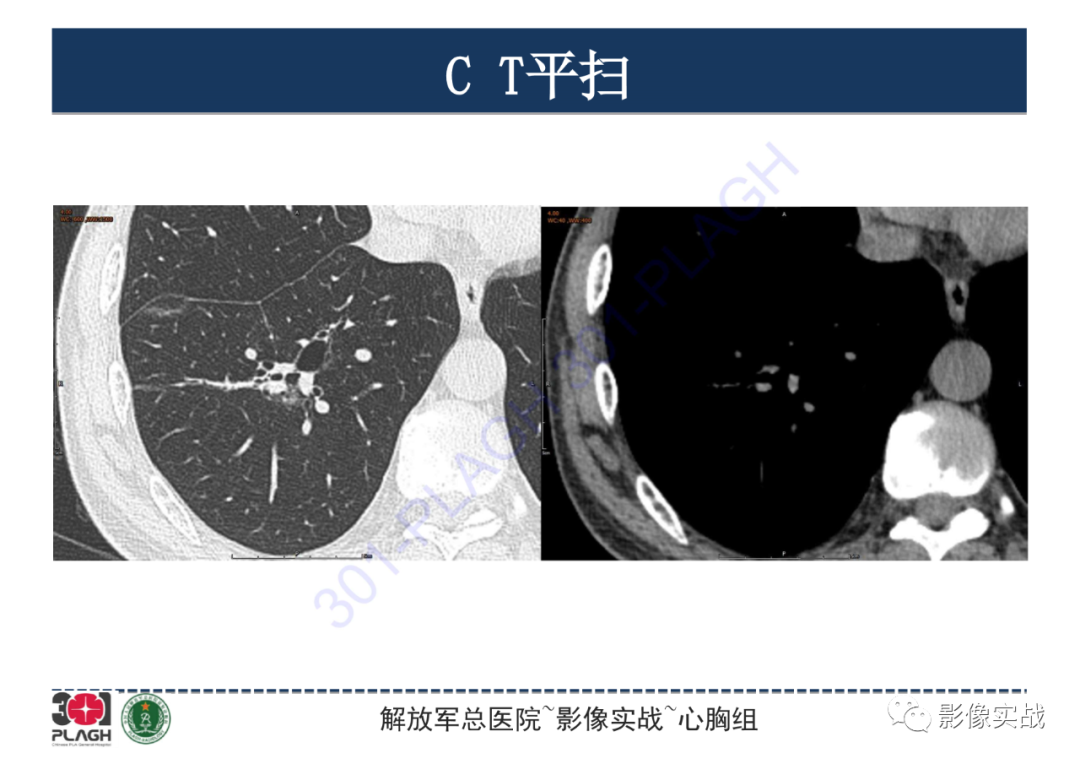 影像PPT - 【PPT】肺浸润性腺癌1例CT-5