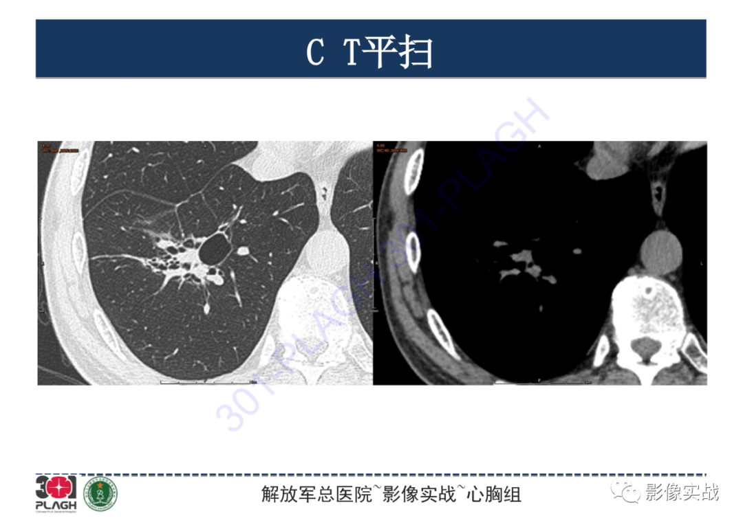 影像PPT - 【PPT】肺浸润性腺癌1例CT-6