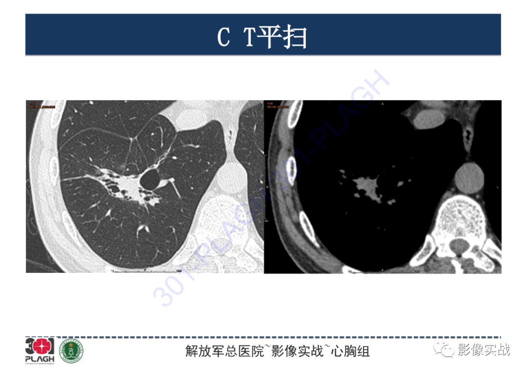 影像PPT - 【PPT】肺浸润性腺癌1例CT-7