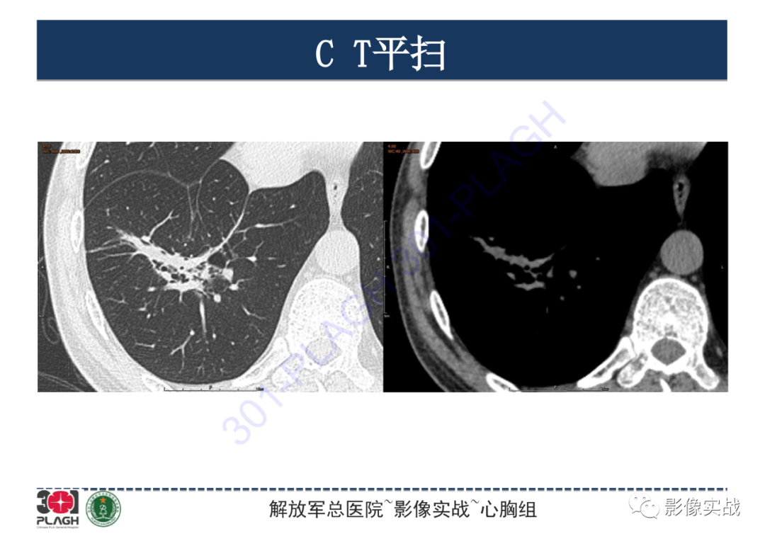 影像PPT - 【PPT】肺浸润性腺癌1例CT-8