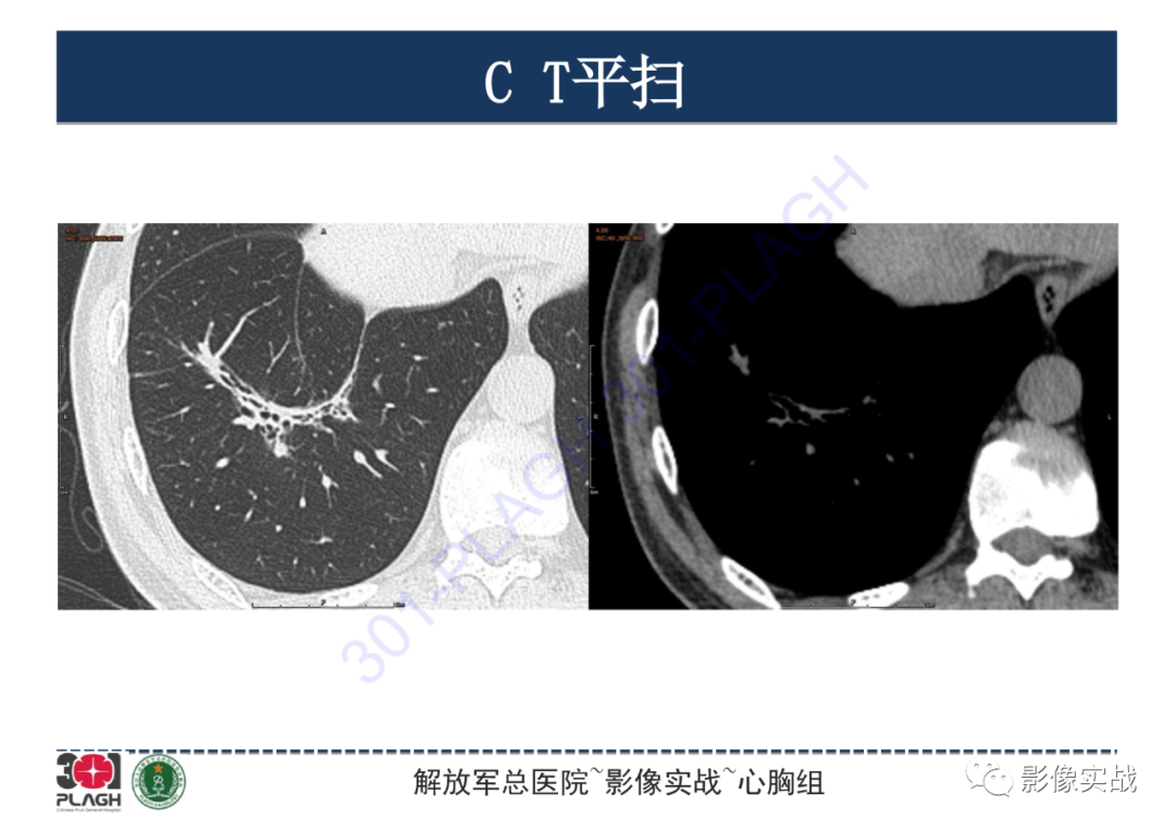 影像PPT - 【PPT】肺浸润性腺癌1例CT-9