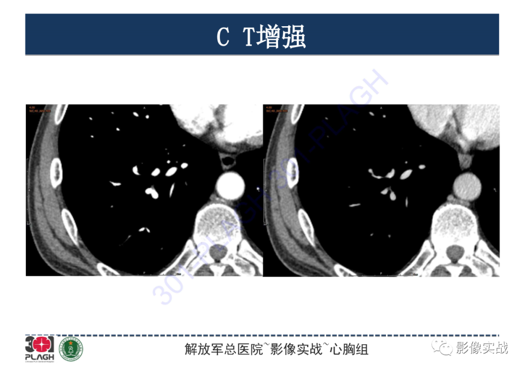 影像PPT - 【PPT】肺浸润性腺癌1例CT-11
