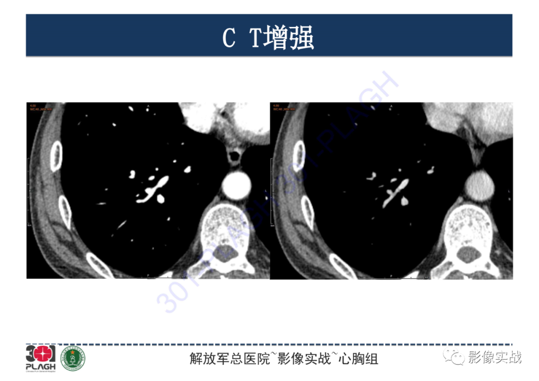影像PPT - 【PPT】肺浸润性腺癌1例CT-12