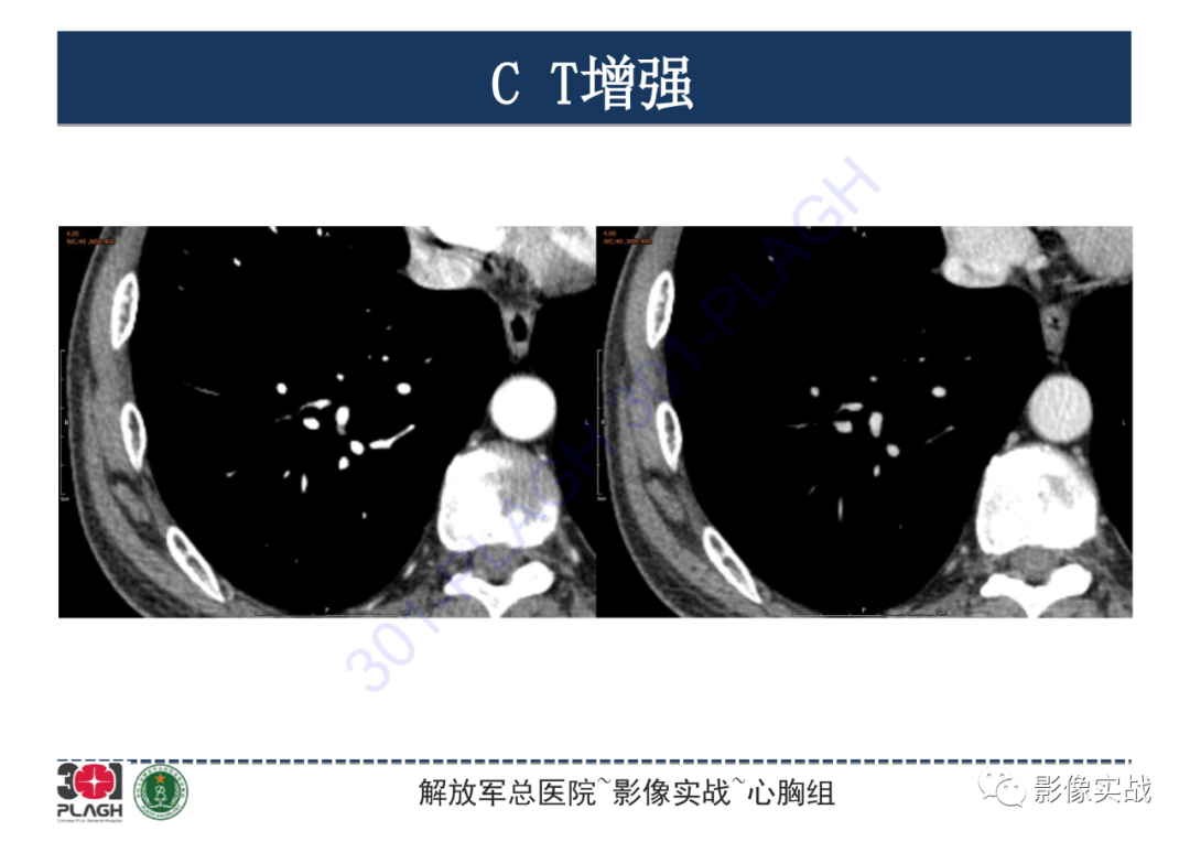 影像PPT - 【PPT】肺浸润性腺癌1例CT-13
