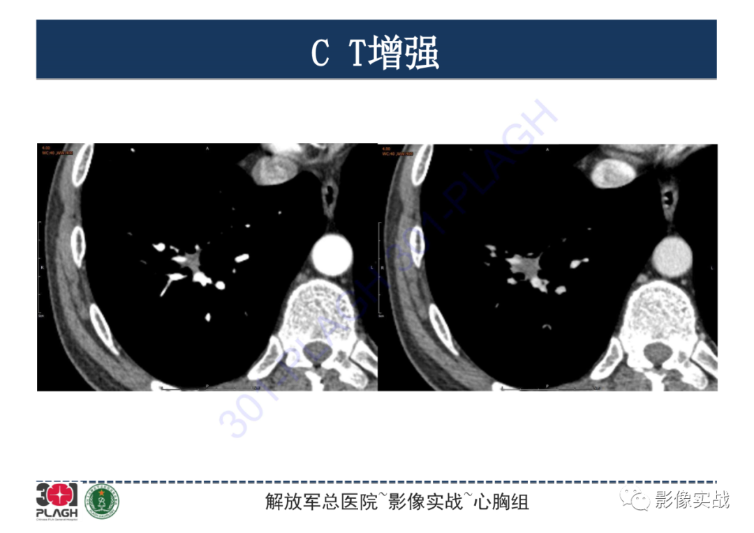 影像PPT - 【PPT】肺浸润性腺癌1例CT-15
