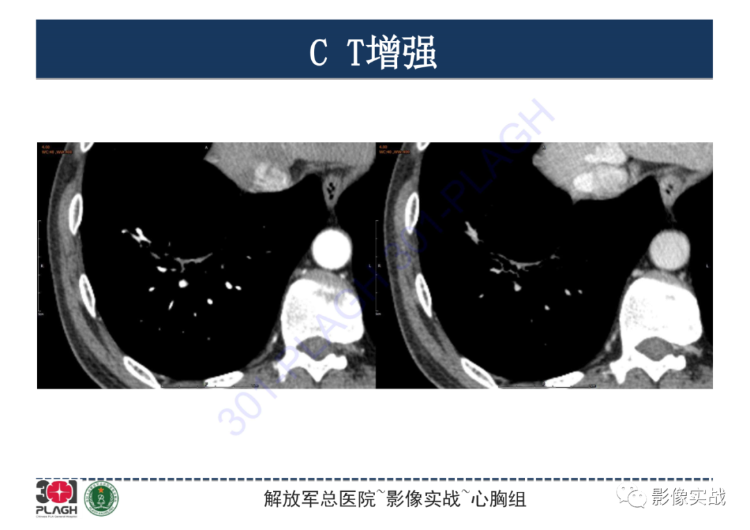 影像PPT - 【PPT】肺浸润性腺癌1例CT-17