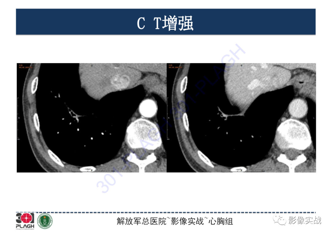影像PPT - 【PPT】肺浸润性腺癌1例CT-18
