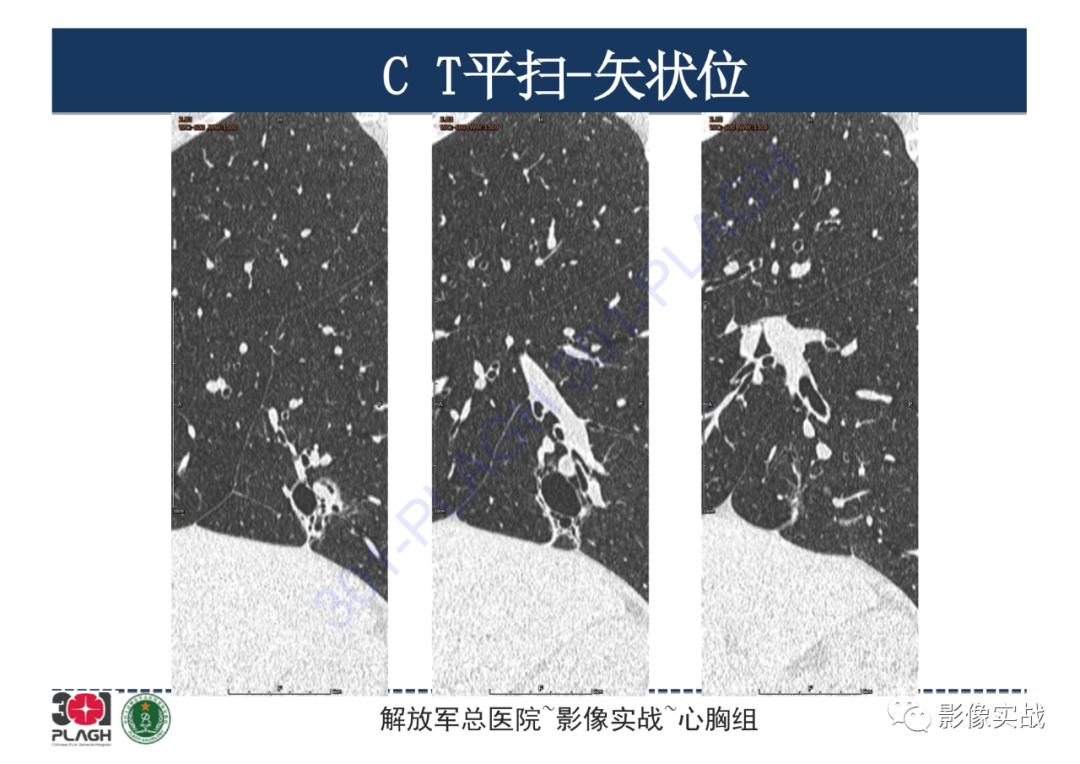 影像PPT - 【PPT】肺浸润性腺癌1例CT-20
