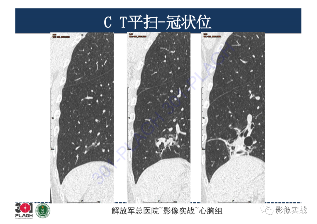 影像PPT - 【PPT】肺浸润性腺癌1例CT-21