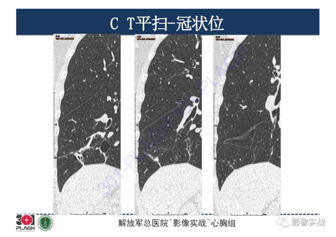 影像PPT - 【PPT】肺浸润性腺癌1例CT-22