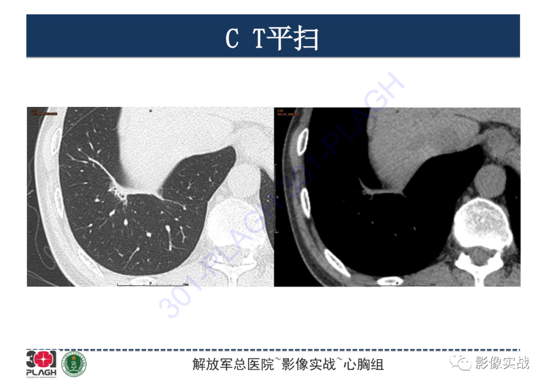 影像PPT - 【PPT】肺浸润性腺癌1例CT-10