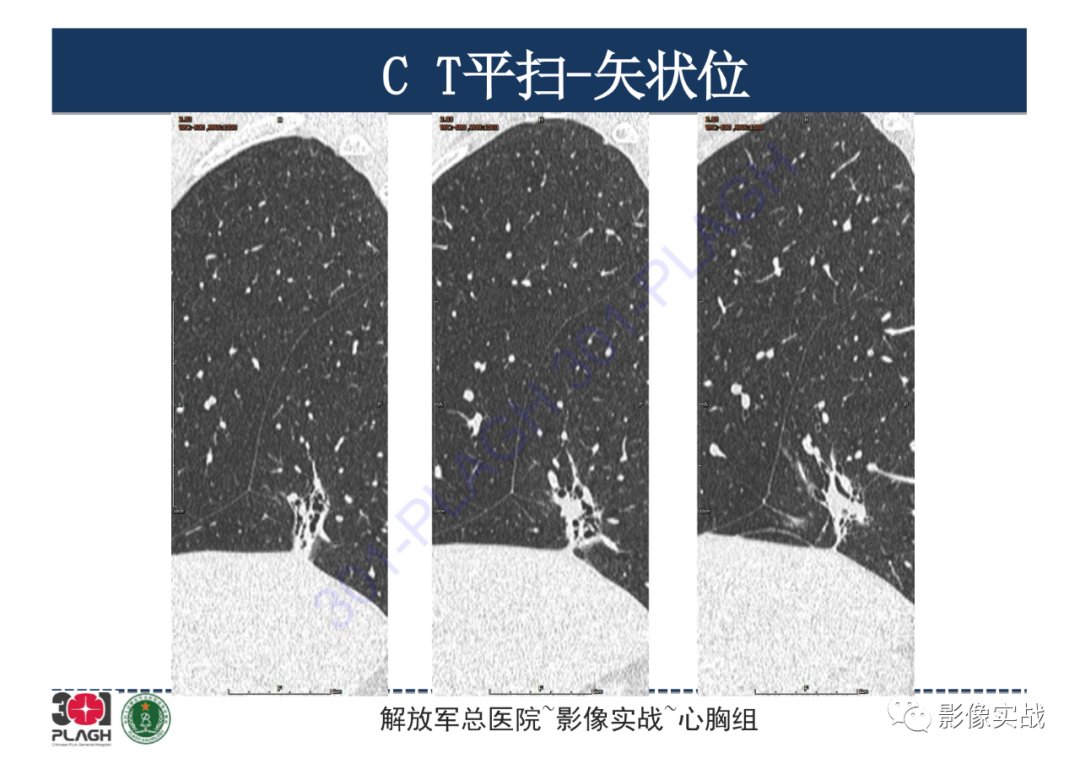 影像PPT - 【PPT】肺浸润性腺癌1例CT-19