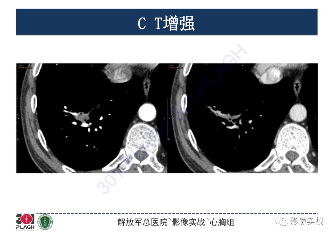 影像PPT - 【PPT】肺浸润性腺癌1例CT-16