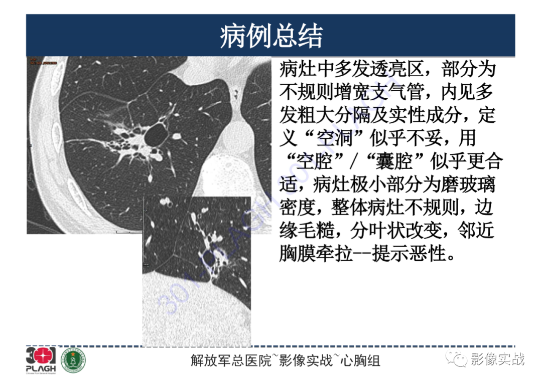 影像PPT - 【PPT】肺浸润性腺癌1例CT-25