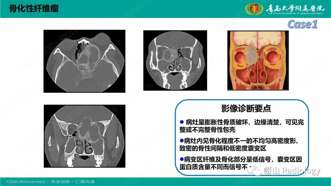 影像PPT - 【PPT】纤维命名相关骨肿瘤和肿瘤样病变的影像学鉴别诊断-11