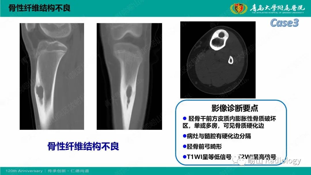 影像PPT - 【PPT】纤维命名相关骨肿瘤和肿瘤样病变的影像学鉴别诊断-14