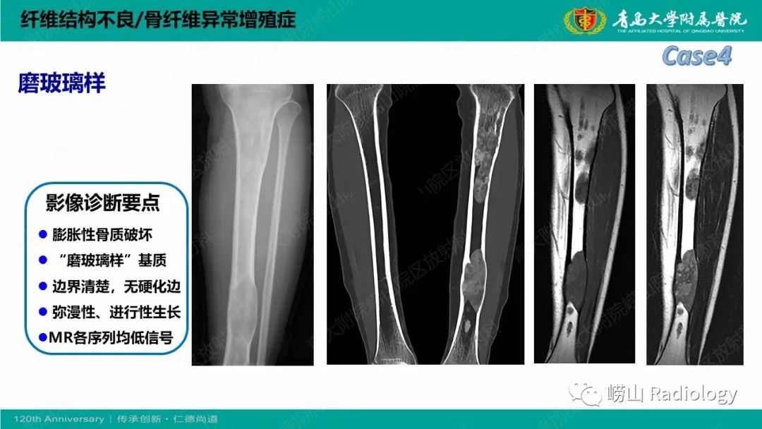 影像PPT - 【PPT】纤维命名相关骨肿瘤和肿瘤样病变的影像学鉴别诊断-17