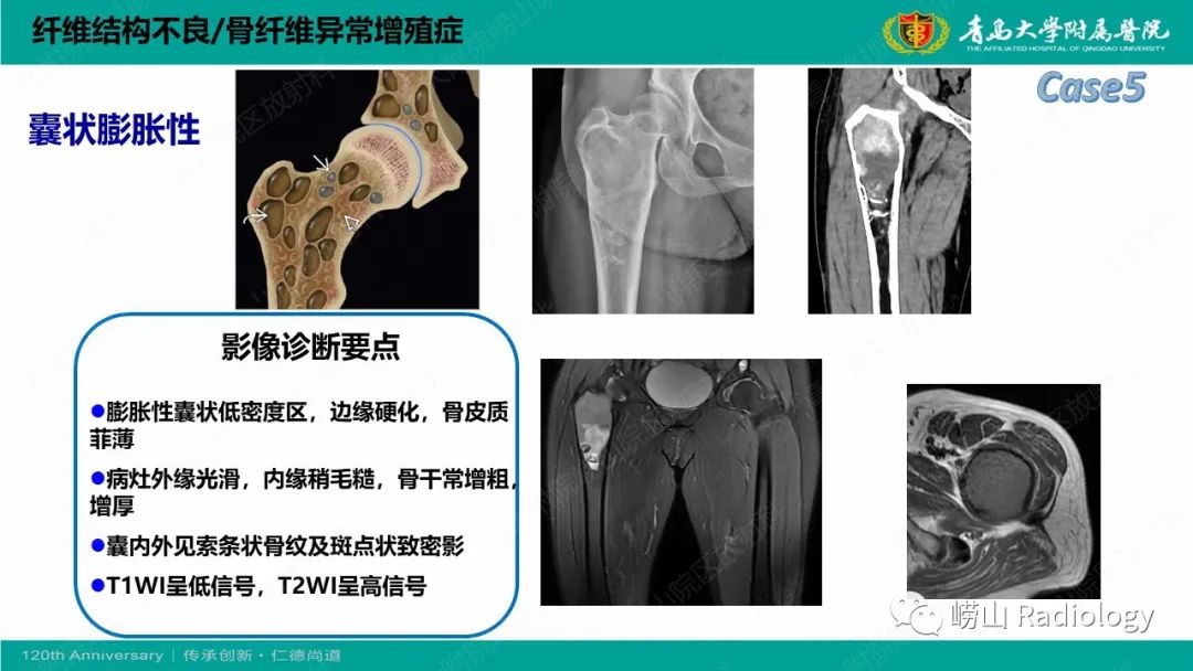 影像PPT - 【PPT】纤维命名相关骨肿瘤和肿瘤样病变的影像学鉴别诊断-18