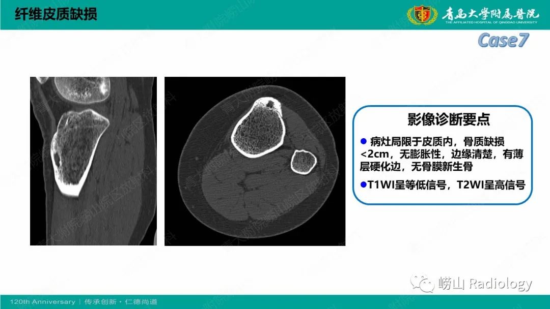 影像PPT - 【PPT】纤维命名相关骨肿瘤和肿瘤样病变的影像学鉴别诊断-21