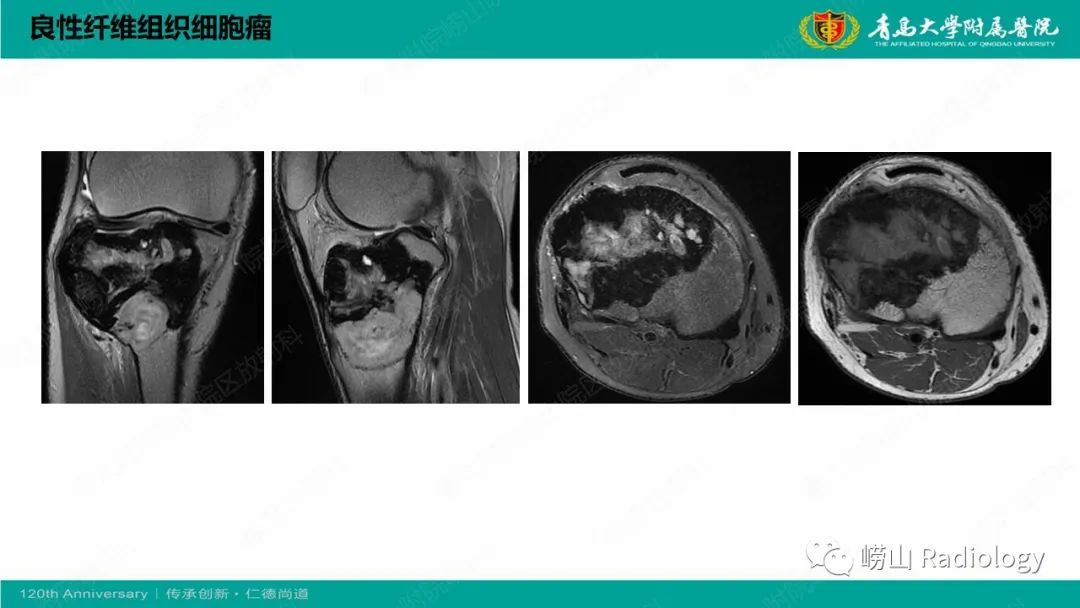 影像PPT - 【PPT】纤维命名相关骨肿瘤和肿瘤样病变的影像学鉴别诊断-28