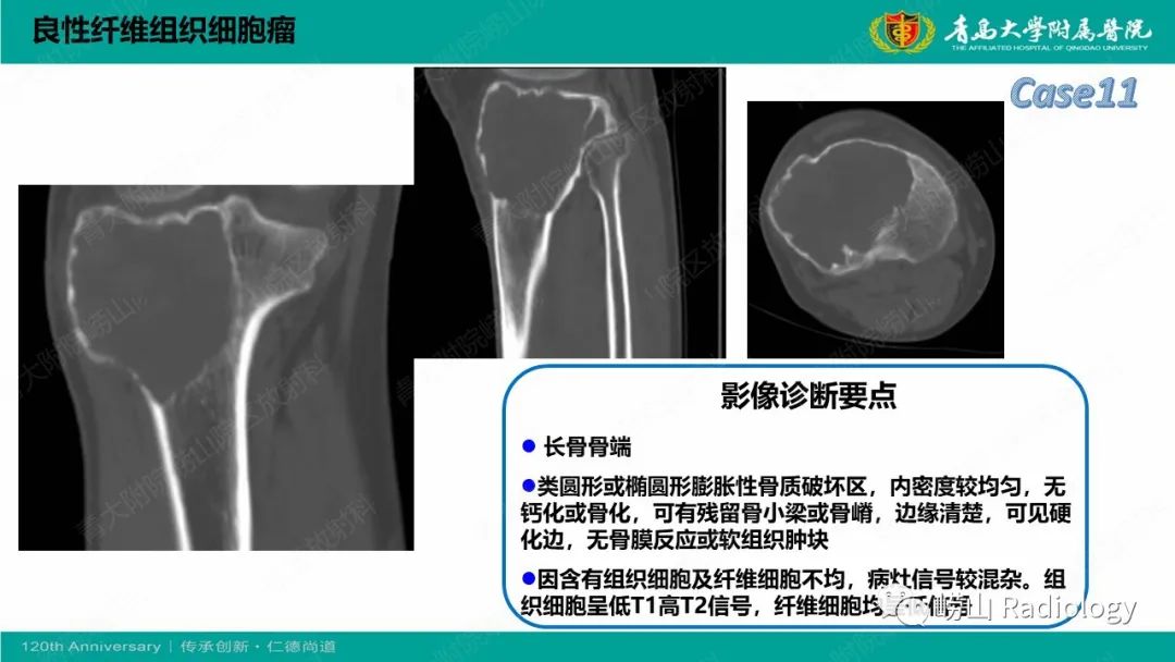 影像PPT - 【PPT】纤维命名相关骨肿瘤和肿瘤样病变的影像学鉴别诊断-27
