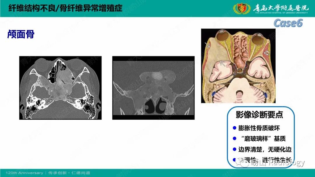 影像PPT - 【PPT】纤维命名相关骨肿瘤和肿瘤样病变的影像学鉴别诊断-19