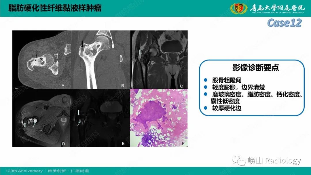 影像PPT - 【PPT】纤维命名相关骨肿瘤和肿瘤样病变的影像学鉴别诊断-30