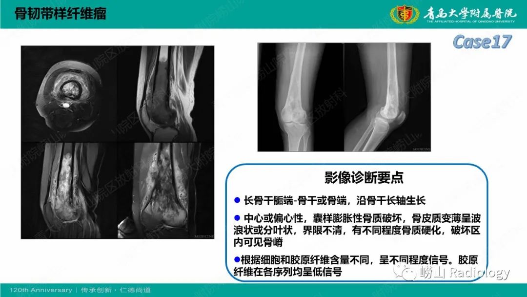 影像PPT - 【PPT】纤维命名相关骨肿瘤和肿瘤样病变的影像学鉴别诊断-38