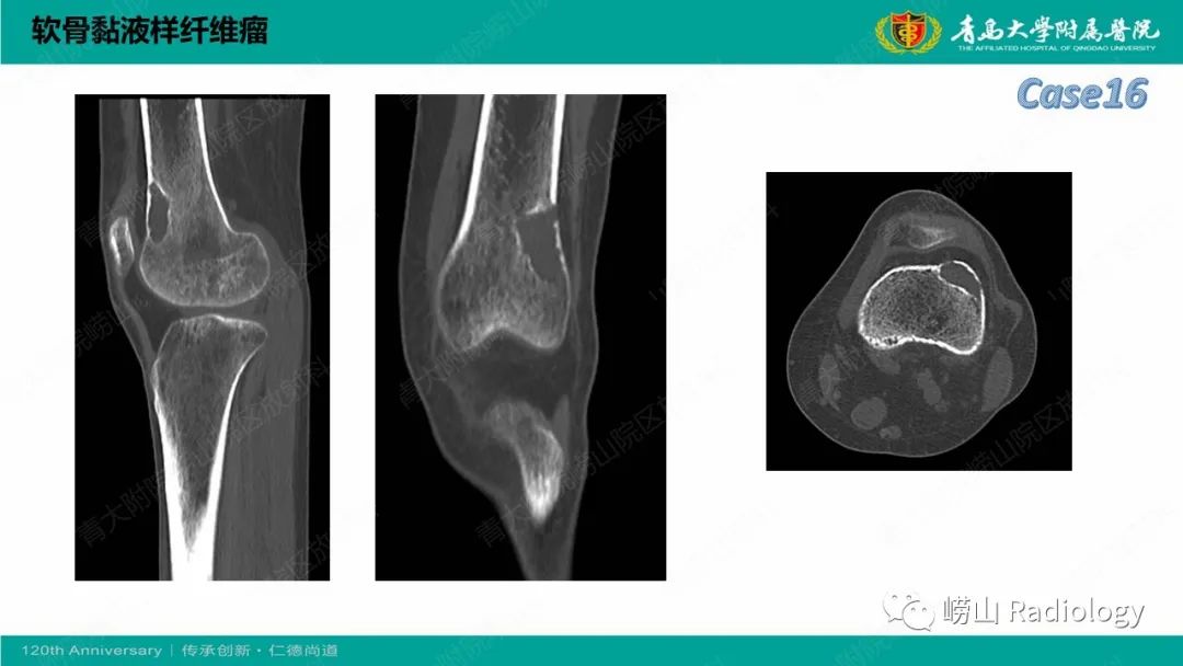 影像PPT - 【PPT】纤维命名相关骨肿瘤和肿瘤样病变的影像学鉴别诊断-35