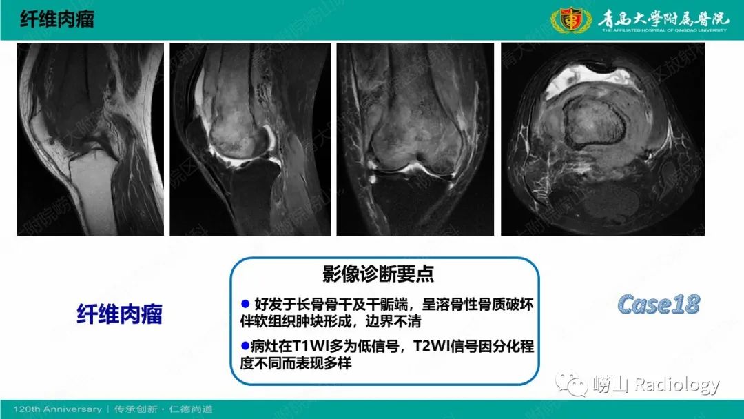 影像PPT - 【PPT】纤维命名相关骨肿瘤和肿瘤样病变的影像学鉴别诊断-40