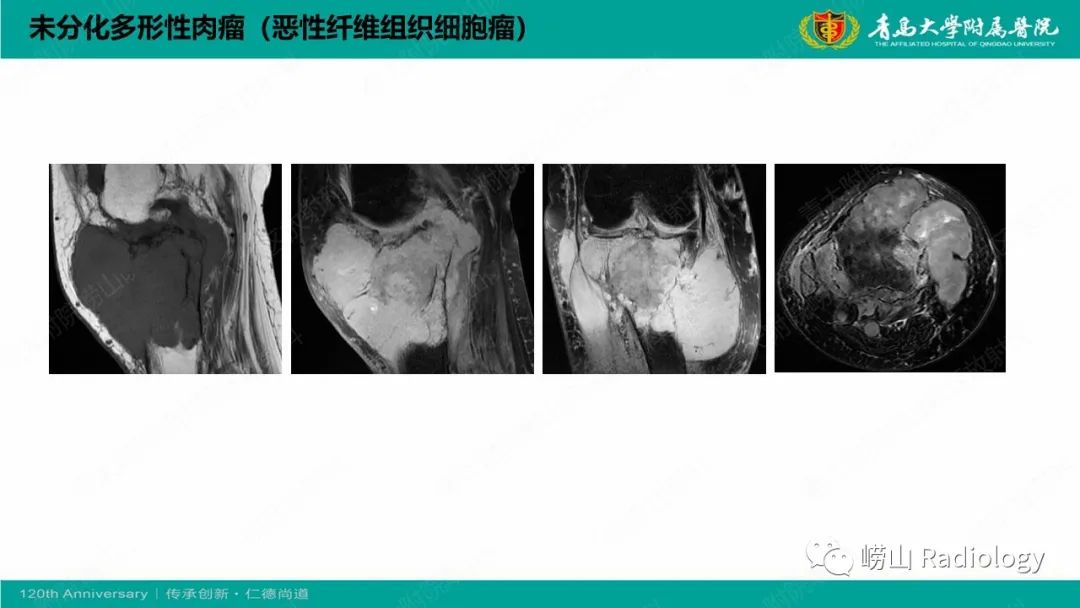 影像PPT - 【PPT】纤维命名相关骨肿瘤和肿瘤样病变的影像学鉴别诊断-43