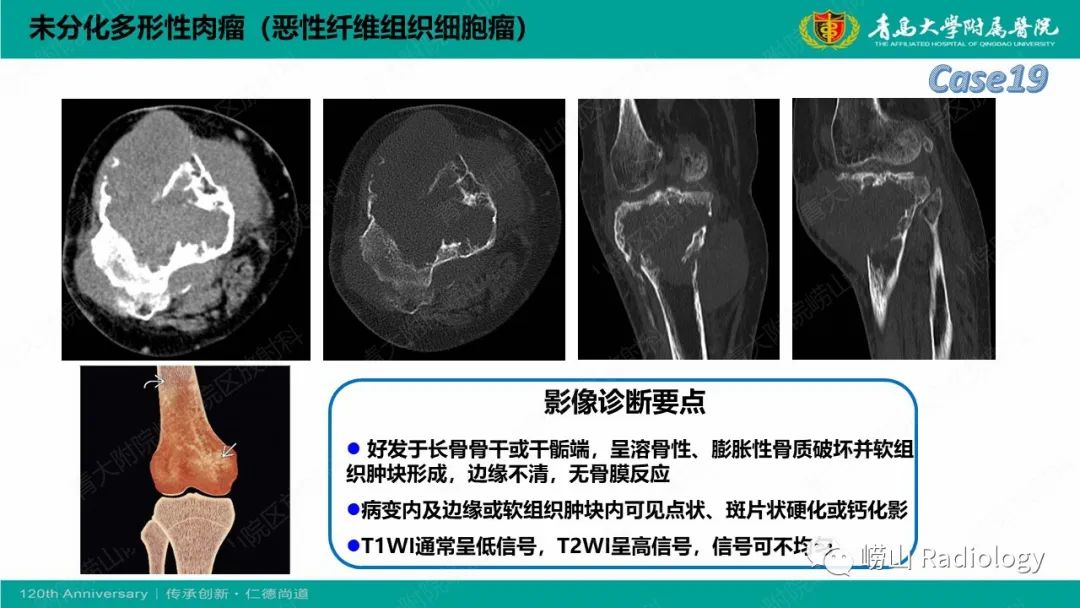 影像PPT - 【PPT】纤维命名相关骨肿瘤和肿瘤样病变的影像学鉴别诊断-42