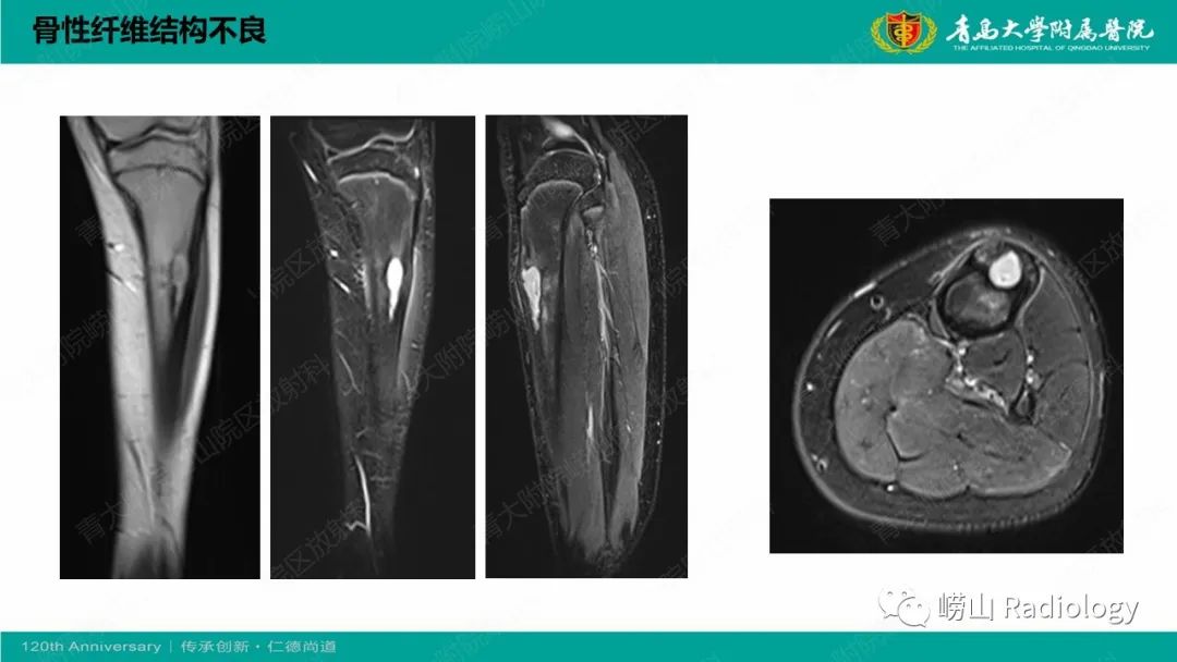 影像PPT - 【PPT】纤维命名相关骨肿瘤和肿瘤样病变的影像学鉴别诊断-15