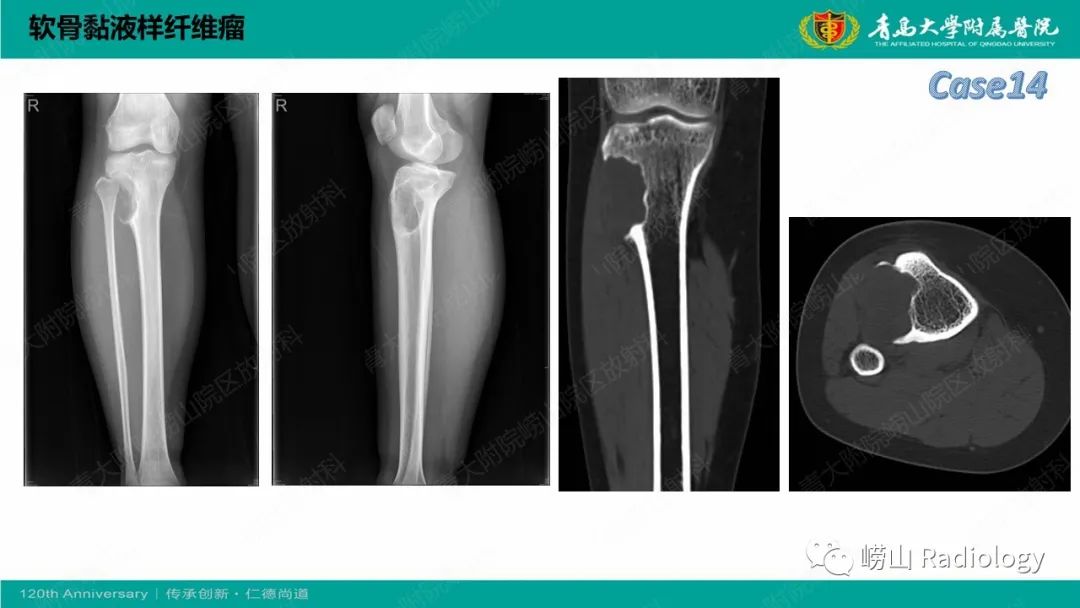 影像PPT - 【PPT】纤维命名相关骨肿瘤和肿瘤样病变的影像学鉴别诊断-33