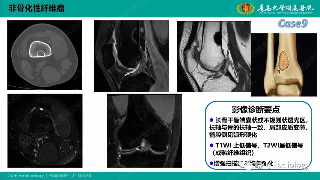 影像PPT - 【PPT】纤维命名相关骨肿瘤和肿瘤样病变的影像学鉴别诊断-24
