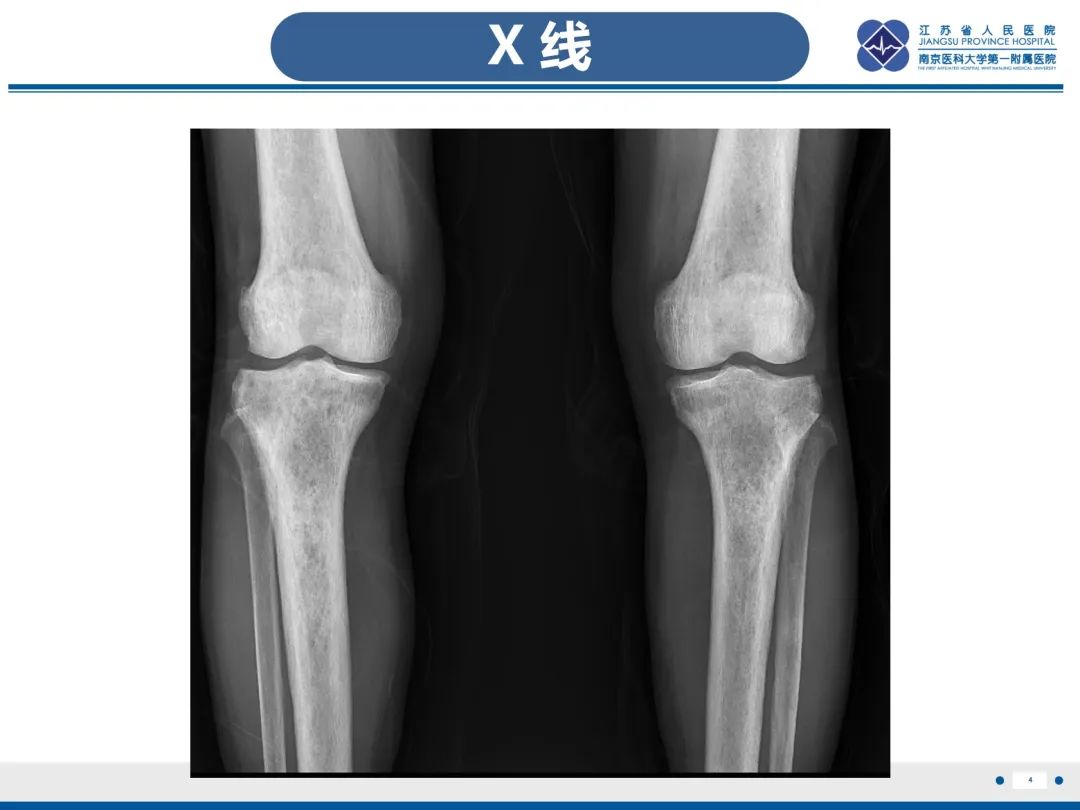 影像PPT - 【PPT】Erdheim-Chester病-5