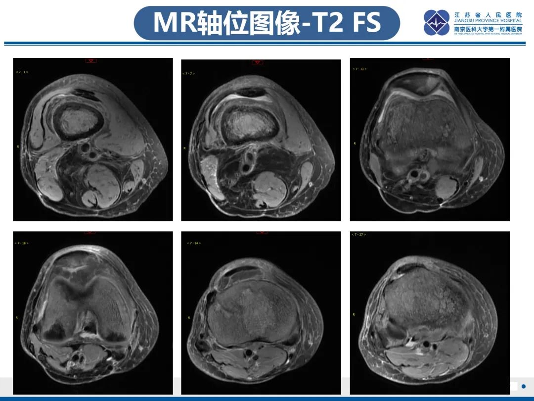 影像PPT - 【PPT】Erdheim-Chester病-8