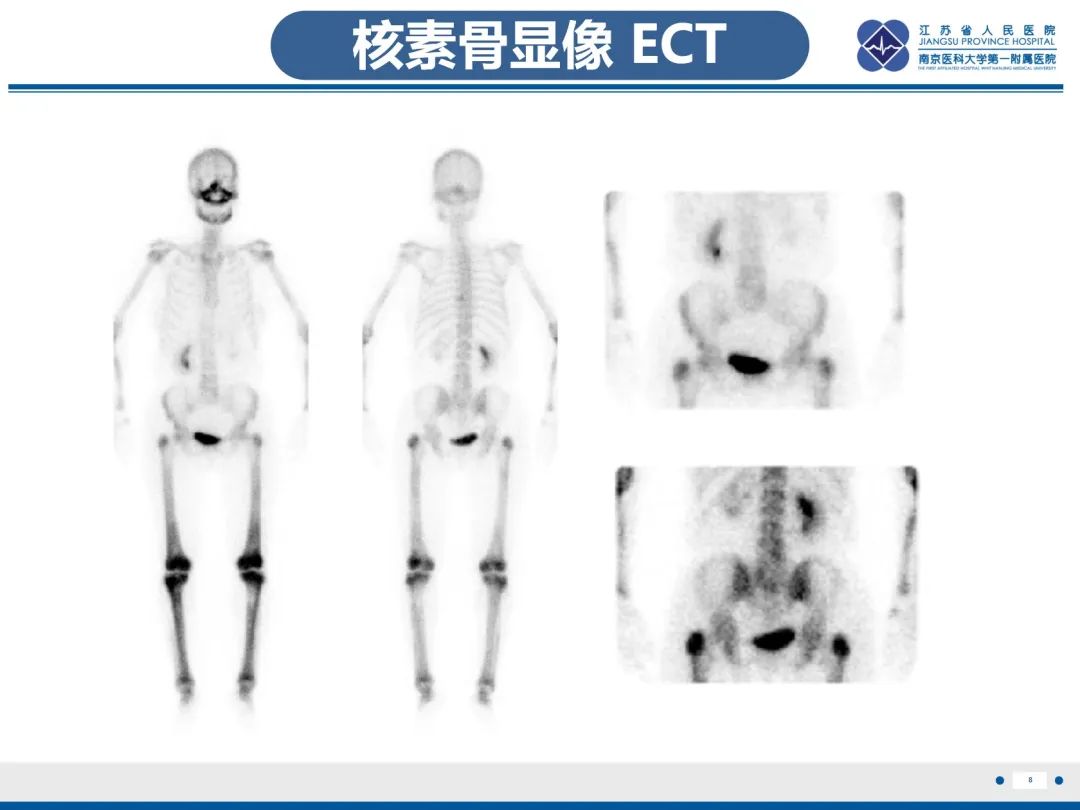 影像PPT - 【PPT】Erdheim-Chester病-9