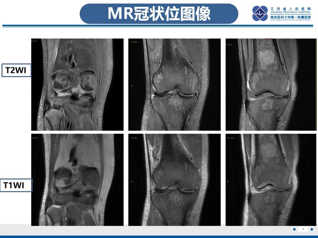 影像PPT - 【PPT】Erdheim-Chester病-7
