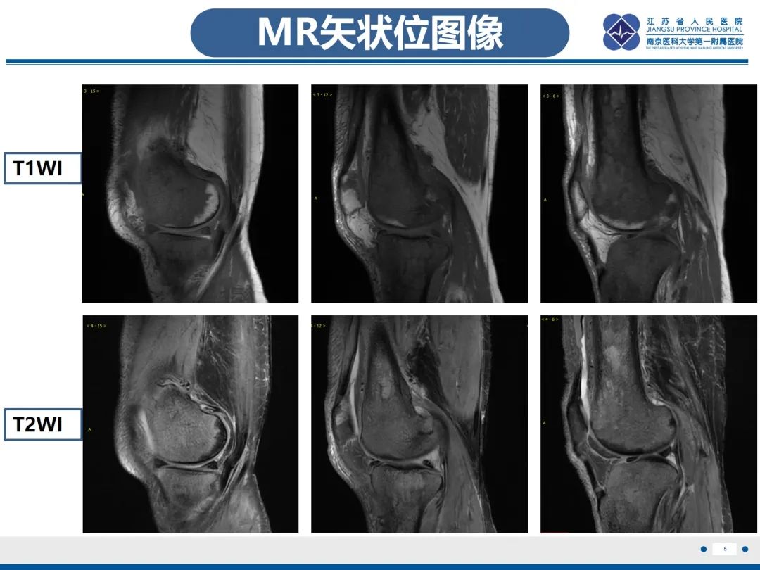 影像PPT - 【PPT】Erdheim-Chester病-6