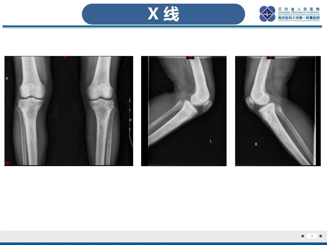 影像PPT - 【PPT】Erdheim-Chester病-4