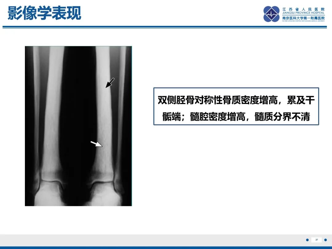 影像PPT - 【PPT】Erdheim-Chester病-28
