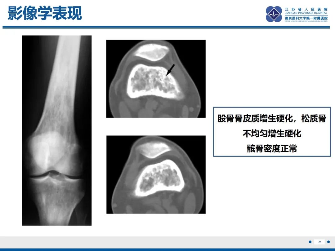 影像PPT - 【PPT】Erdheim-Chester病-30